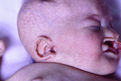 trisomia-18-edwards-mano-trisomica-mar-anoplastia-1m-13d-1992-005
