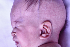 trisomia-18-edwards-mano-trisomica-mar-anoplastia-1m-13d-1992-006