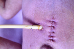 trisomia-18-edwards-mano-trisomica-mar-anoplastia-1m-13d-1992-009