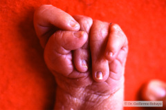 trisomia-18-edwards-mano-trisomica-000