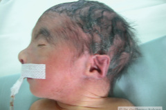 trisomia-18-edwards-mar-fistula-inclinacion-antimongoloide-criptorquidia-2005-000