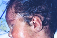 trisomia-18-edwards-000