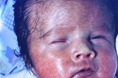 trisomia-18-edwards-001