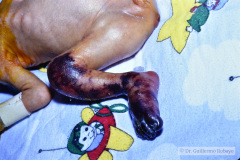 trombosis-femoral-necrosis-pierna-der-1993-003