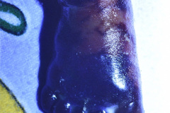trombosis-femoral-necrosis-pierna-der-1993-005