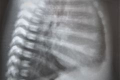 tronco-arterial-arterioso-cardiomegalia-hiperflujo-pulmonar-1997-000