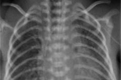 tubo-endotraqueal-alto-cateter-epicutaneo-brazo-izq-2009-000