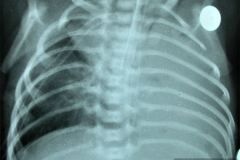 tubo-endotraqueal-sobreinsertado-der-atelectasia-masiva-izq-neumototax-der-000