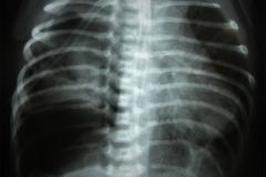 tubo-endotraqueal-sobreinsertado-der-atelectasia-masiva-izq-neumototax-der-001