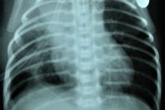 tubo-endotraqueal-sobreinsertado-der-atelectasia-masiva-izq-neumototax-der-002