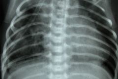 tubo-endotraqueal-sobreinsertado-der-atelectasia-masiva-izq-neumototax-der-003
