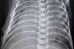 tubo-endotraqueal-sobreinsertado-izq-tubo-torax-der-1990-000