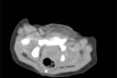 tumor-wilms-2007-005