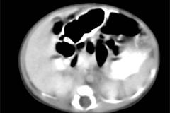 tumor-wilms-2007-008