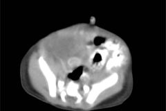 tumor-wilms-2007-009