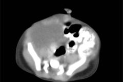 tumor-wilms-2007-010