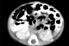 tumor-wilms-2007-011
