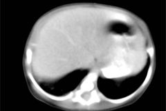 tumor-wilms-2007-013