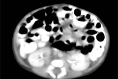 tumor-wilms-2007-017