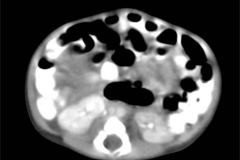 tumor-wilms-2007-018