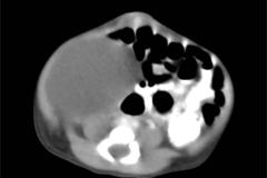 tumor-wilms-2007-021