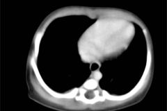 tumor-wilms-2007-027
