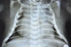 turner-cardiomegalia-1994-001