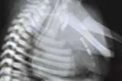 turner-cardiomegalia-1994-002