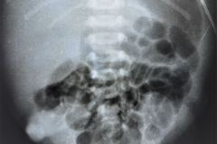 turner-cardiomegalia-1994-010