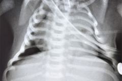 turner-cardiomegalia-1994-011