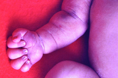 turner-monosomia-xo-edema-miembros-001
