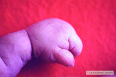 turner-monosomia-xo-edema-miembros-003