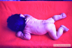 turner-monosomia-xo-edema-miembros-008
