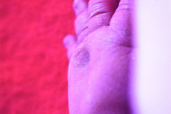 turner-monosomia-xo-edema-miembros-009