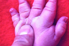 turner-monosomia-xo-edema-miembros-013