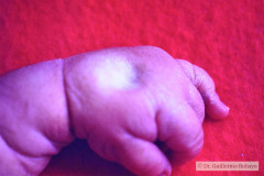 turner-monosomia-xo-edema-miembros-017