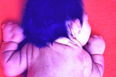 turner-monosomia-xo-edema-miembros-018