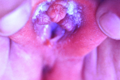 turner-monosomia-xo-edema-miembros-020
