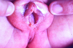 turner-monosomia-xo-edema-miembros-021