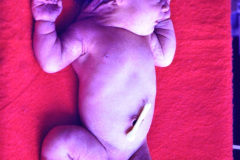 turner-monosomia-xo-edema-miembros-027