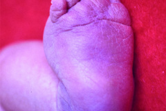 turner-monosomia-xo-edema-miembros-035