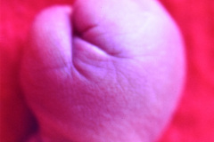 turner-monosomia-xo-edema-miembros-036