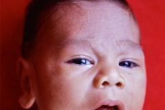 turner-monosomia-xo-pterygium-colli-candidiasis-oral-1989-002