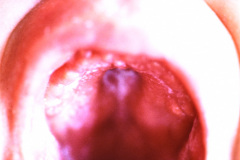 turner-monosomia-xo-pterygium-colli-candidiasis-oral-1989-007