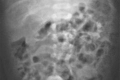turner-monosomia-xo-urografia-ecografia-renograma-dpta-004