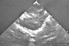 turner-monosomia-xo-urografia-ecografia-renograma-dpta-018
