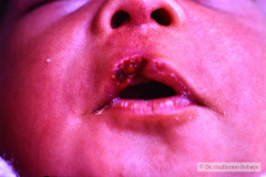ulceracion-espatulas-labio-superior-1985-001