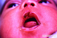 ulceracion-espatulas-labio-superior-1985-002