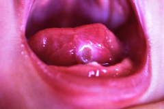 ulceracion-por-diente-neonatal-1985_08_29-000