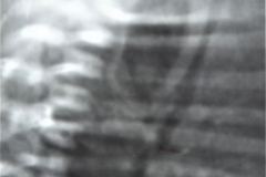 vacter-fusion-vertebral-cardiopatia-fistula-traqueoesofagica-atresia-esofago-1985-001